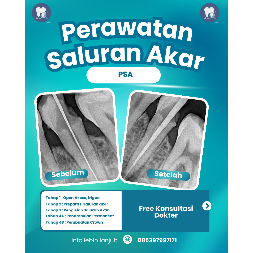 Perawatan Saluran Akar + Konsultasi Dokter
