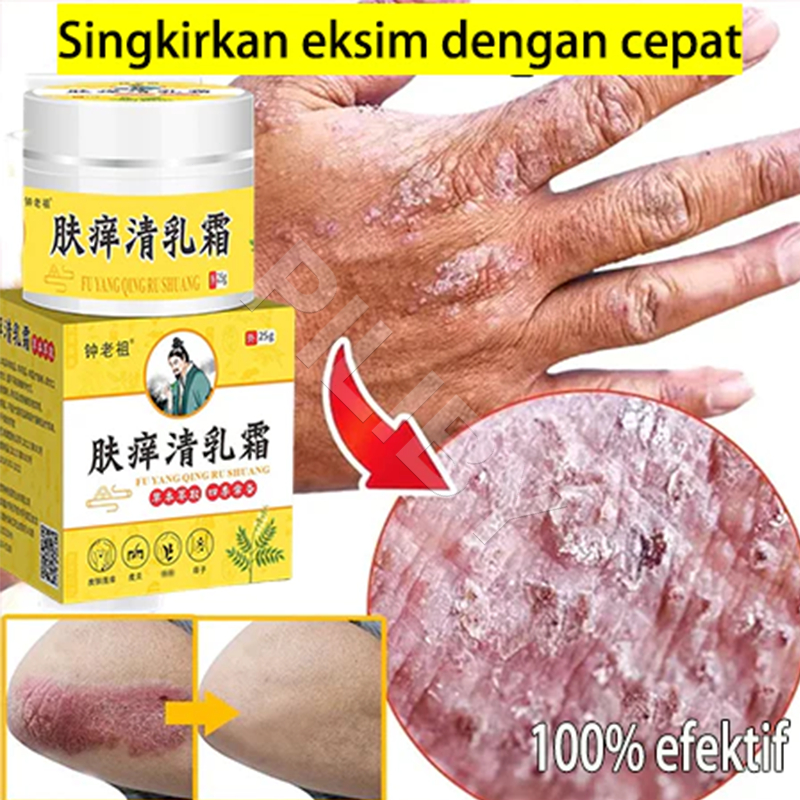 salep china gatal paling ampuh Salep Eksim Kering dan Gatal Salep Bayi Untuk Kulit Iritasi obat eksi