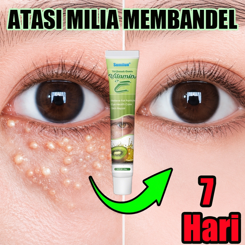 Salep Milia Krim Penghilang Milia Syringoma Xanthelasma Butiran Lemak Sekitar Mata Milium 0bat Milia