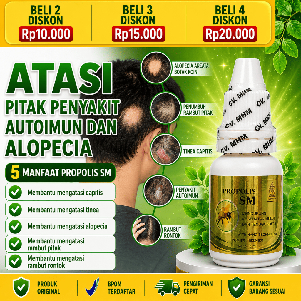 PROPOLIS SM Obat Alopecia Areata Botak Koin Penumbuh Rambut Pitak Penyakit Autoimun Tinea Capitis