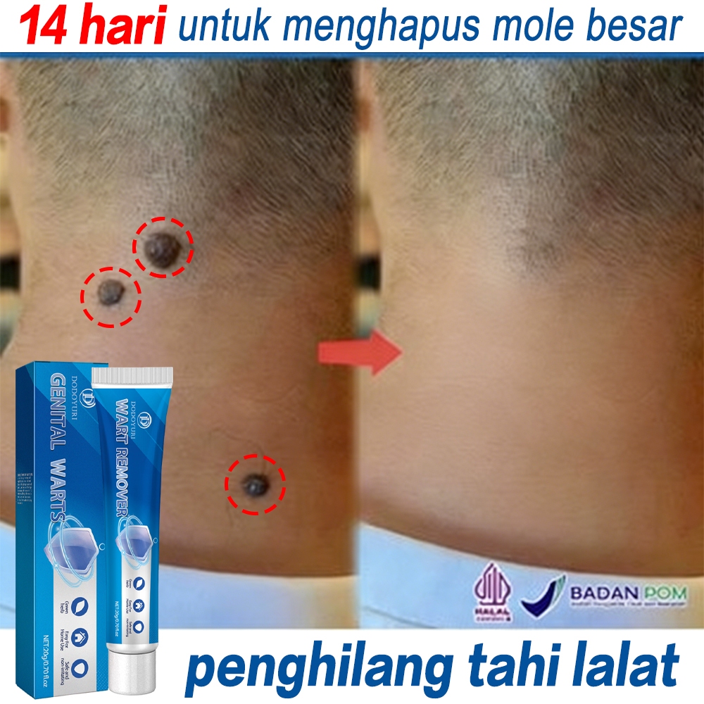 Obat tahi lalat Penghilang tahi lalat hidup Penghilang tahi lalat mati Obat tai lalat Salep penghila