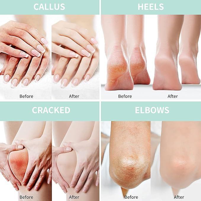 Urea Cream 42 Persen Krim Kaki Kering Tumit Pecah Pecah Dan Tangan Kasar Dengan Hyaluronic Acid Aloe