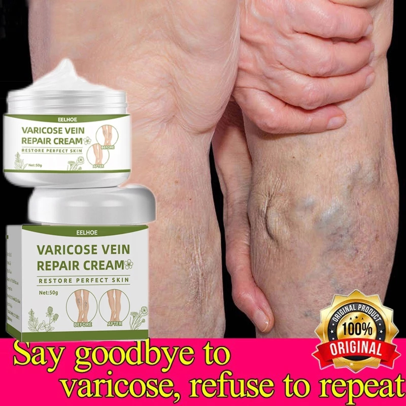 Krim perbaikan vena Obat varises Krim varises Krim penghilang bekas luka Krim penghilang varises Kri