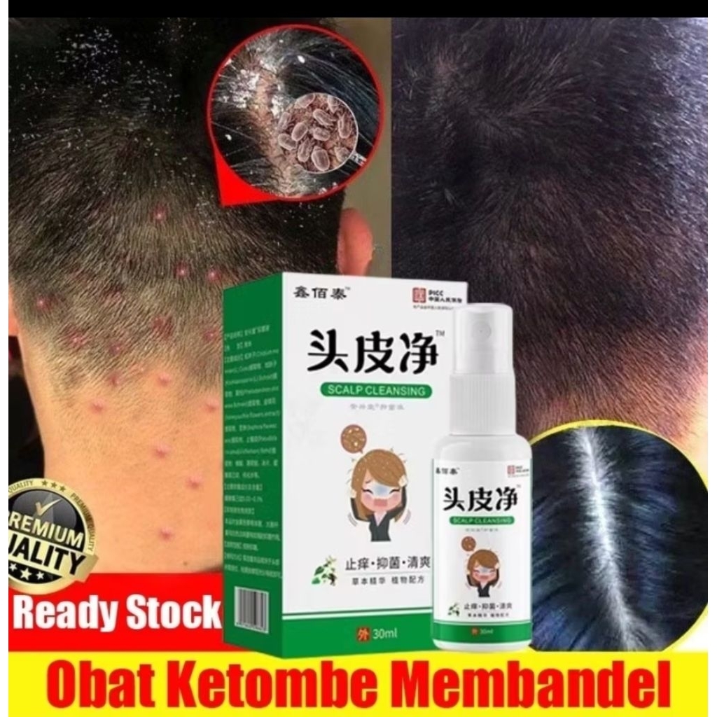 Obat Ketombe Paling Ampuh Obat Ketombe Membandel dan Gatal Kulit Kepala Permanen