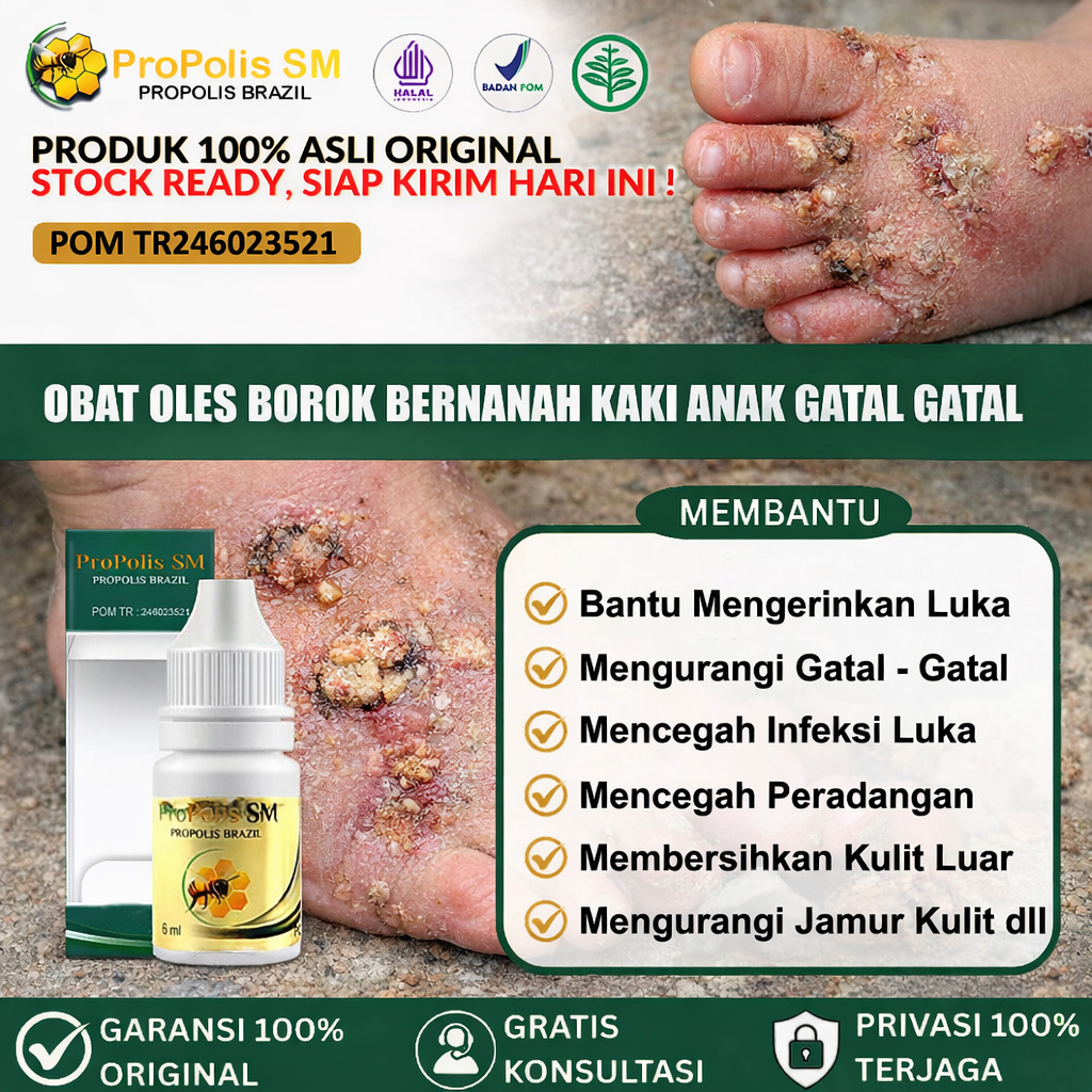 Obat Borok Di Kaki Anak, Kulit Bernanah Pada Anak, Menyembuhkan Luka Borok,  Korengan Di Anak, Penge