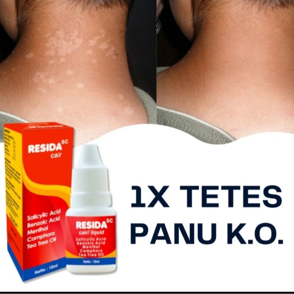 RESIDA CAIR = KALPANAK CAIR - obat panu paling ampuh 100% menghilang panu kadas kurap kutuair kudis