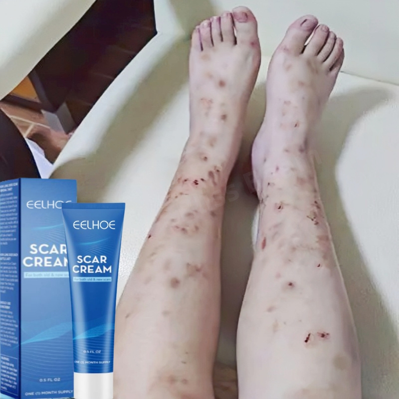 Salep penghilang bekas luka Penghilang bekas luka hitam koreng Penghilang bekas luka di kaki Penghil