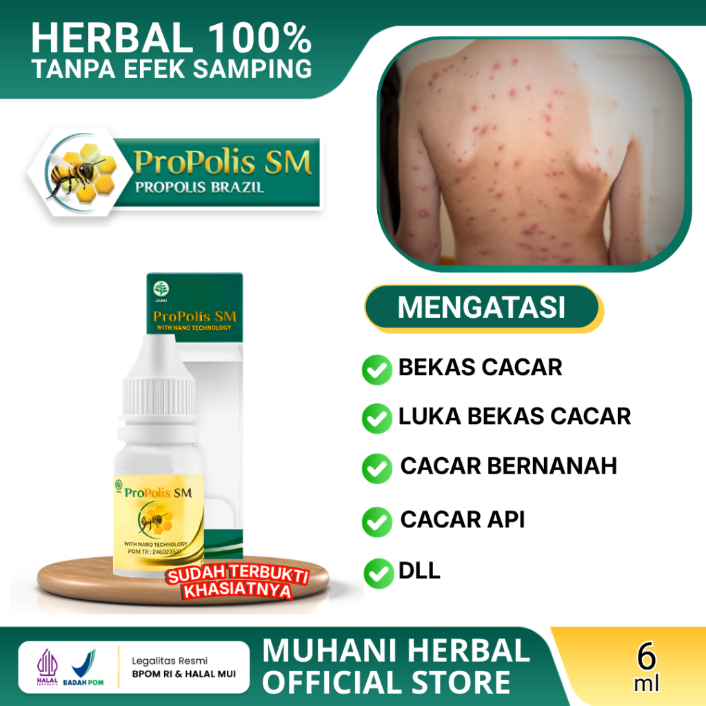 Obat Penghilang Bekas Cacar Propolis SM BPOM Luka Bekas Korengan, Cacar Bernanah, Cacar Api