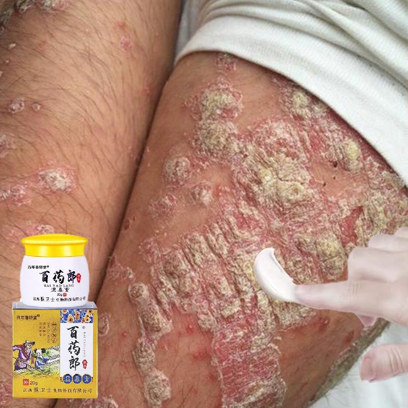 Salep gatal china paling ampuh Salep Gatal Selangkangan Obat Jamur Kulit Psoriasis Cream Obat Eksim 