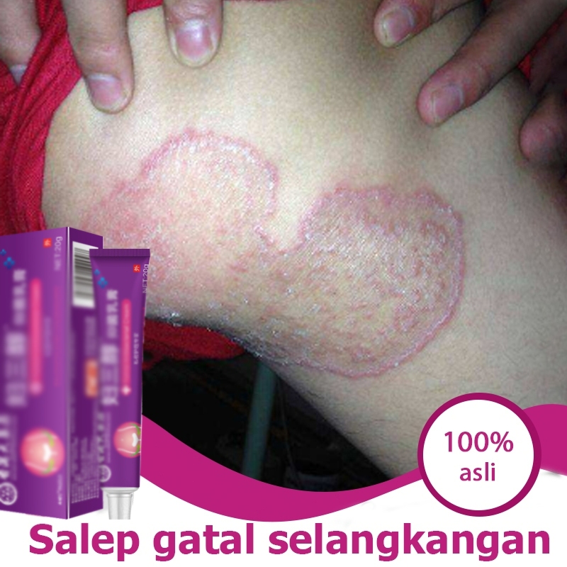 Salep gatal selangkangan salep tinea krim antipruritik paling efektif salep gatal selangkangan 20g k