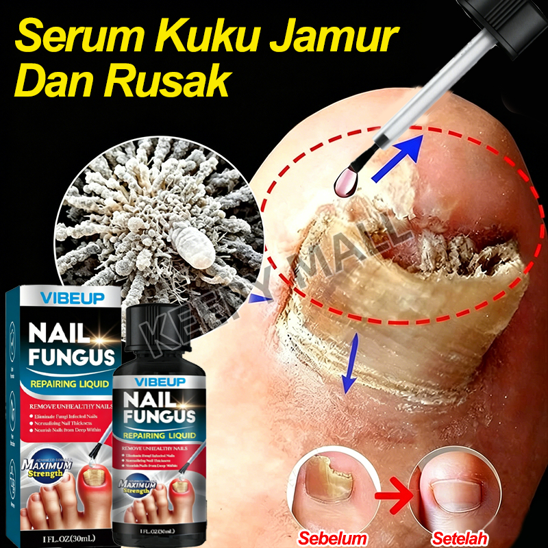 Serum Kuku Jamur Dan Rusak Obat Cantengan Kuku Ampuh Obat Jamur Kuku Kaki Obat Kuku Berjamur Penumbu