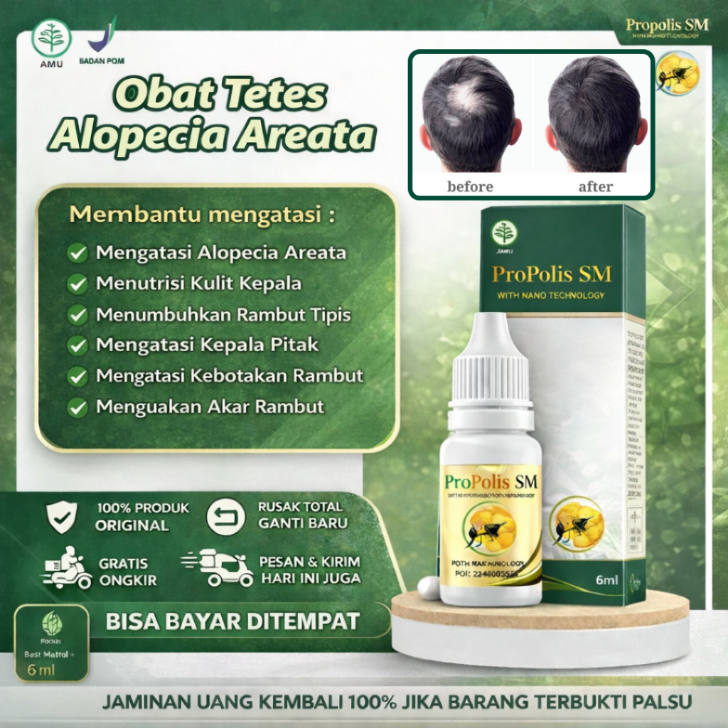 Obat Alopecia Areata Penumbuh Rambut Rontok Botak Pitak Autoimun Botak Ditengah Penghilang Botak