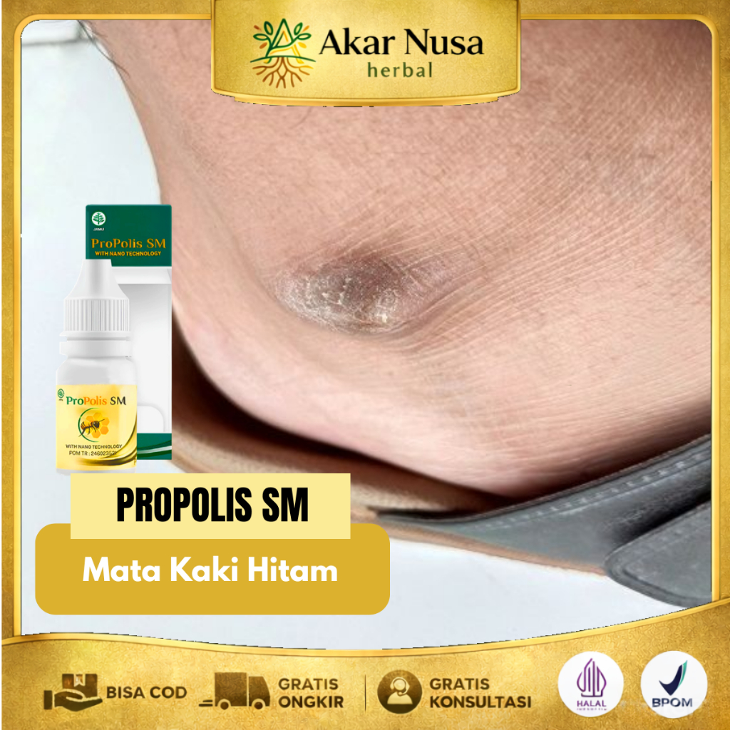 Obat Mata Kaki Hitam Obat Kaki Kapalan Kaki Rayapan - Propolis SM