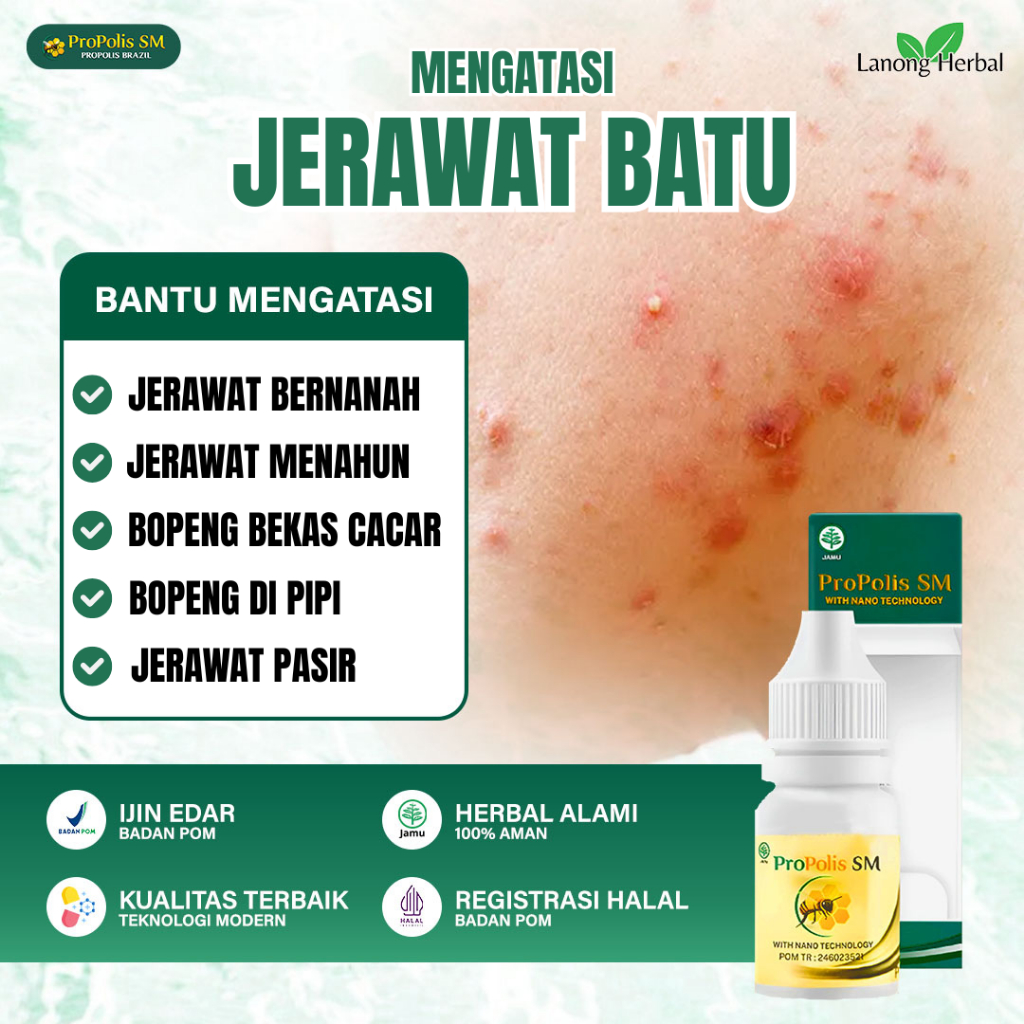 Propolis SM ASLI BPOM - Obat Jerawat Batu, Jerawat Besar & Beruntusan - Penghilang Bekas Jerawat Ala