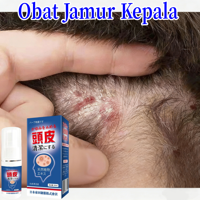 Obat Ketombe Membandel Kepala Gatal Ketombe Berkerak Kulit Kepala Koreng Kulit Kepala Bersisik Ketom