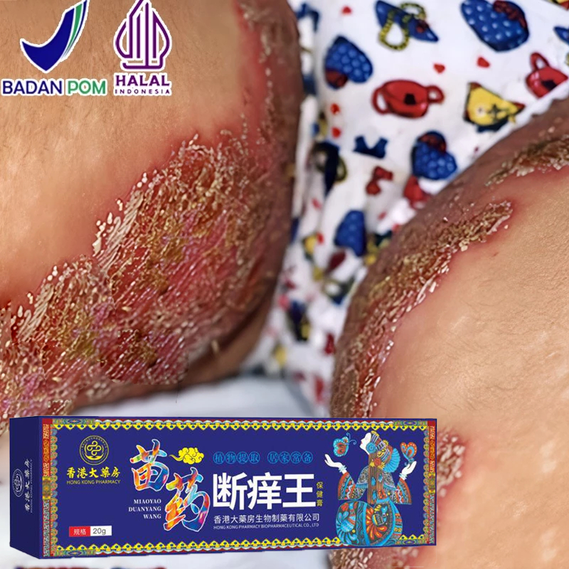 oba gatal paling ampuh salep china gatal paling ampuh saleb gatal paling ampuh salep gatal salep jam