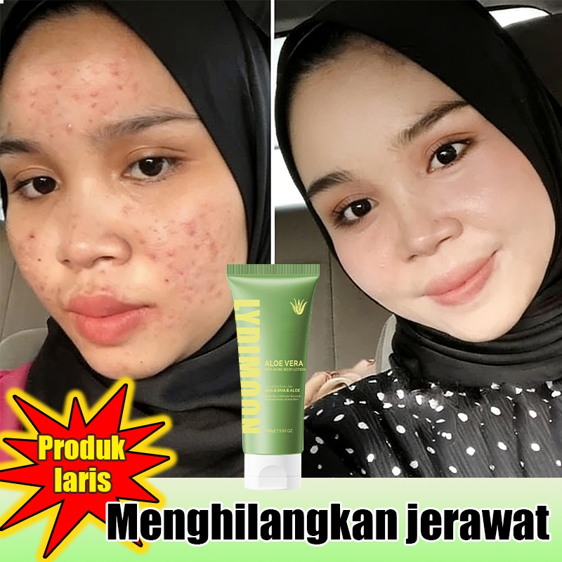 Aloevera gel moisturizer aloevera gel  Memperbaiki Bekas Jerawat Luka Bakar Akibat Terik Matahari  M