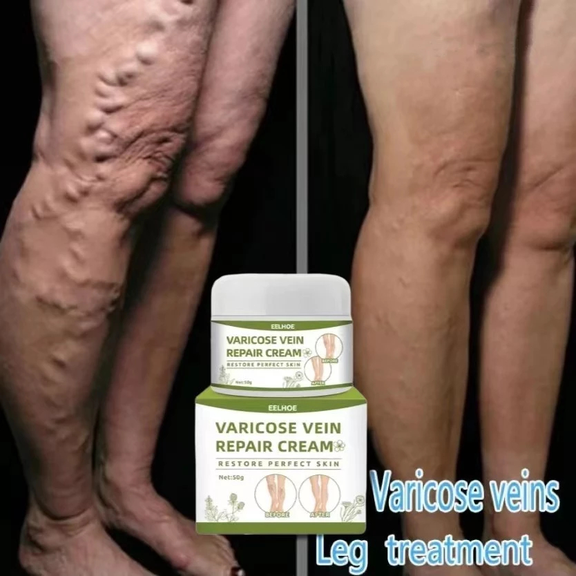 Varicose Veins Cream Obat Varises Salep Penghilang Varises Vaskulitis Ampuh Tanpa Operasi / Obat Sal
