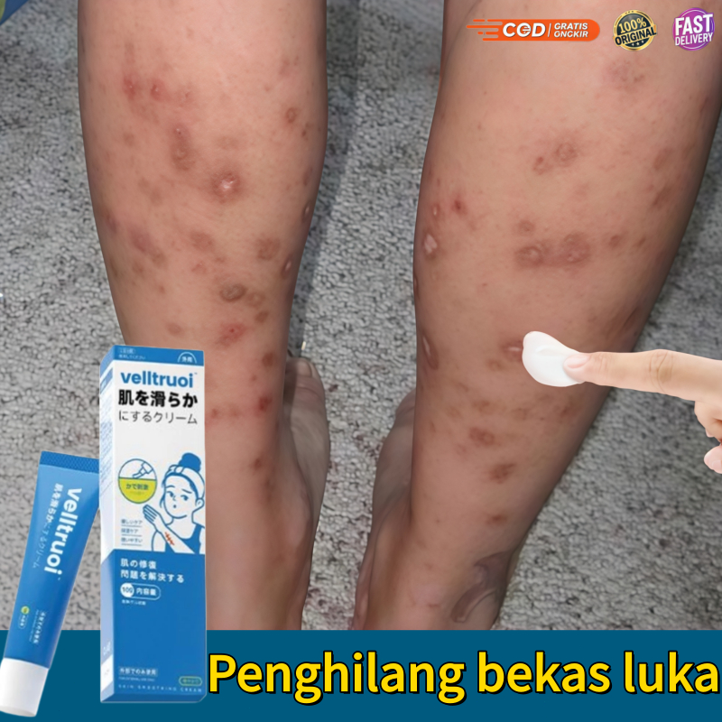 Salep penghilang bekas luka Menghilangkan bekas luka menghitam Salep keloid Cream penghilang bekas l