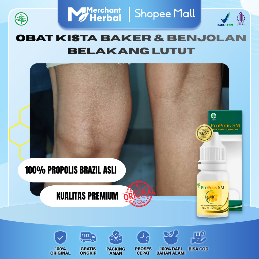 Kista Baker & Benjolan Belakang Lutut – Propolis SM