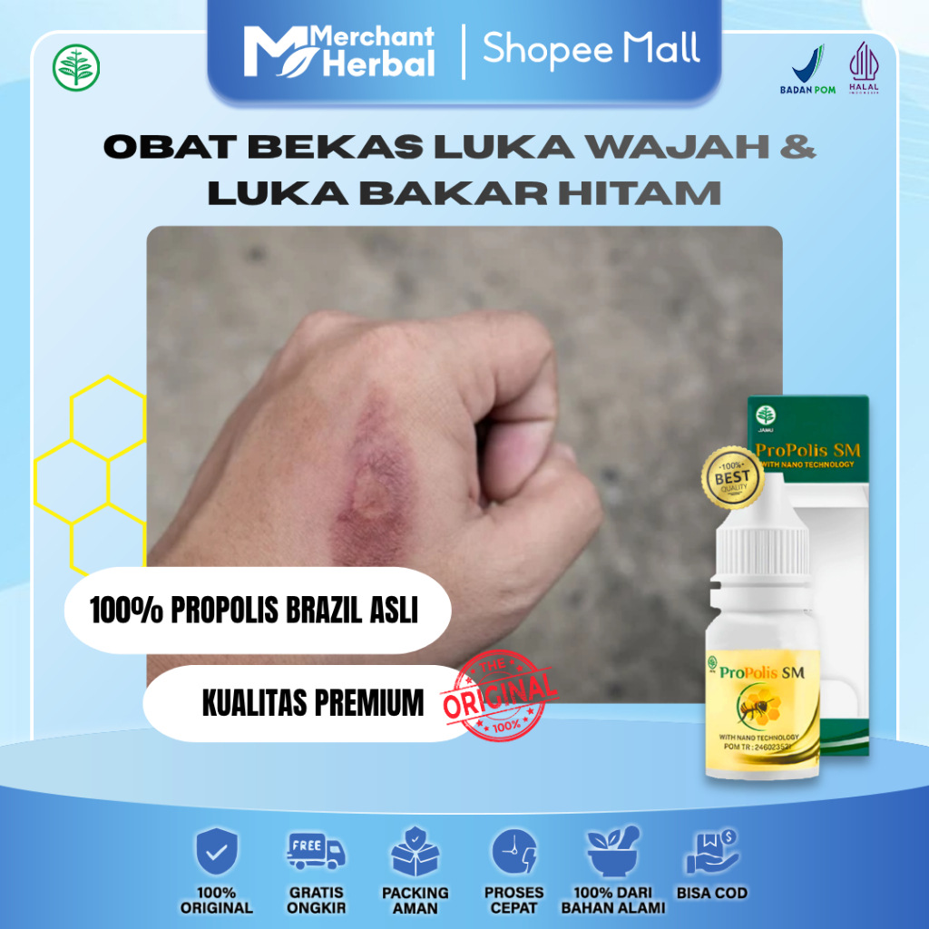 BEKAS LUKA WAJAH & LUKA BAKAR HITAM – Propolis SM