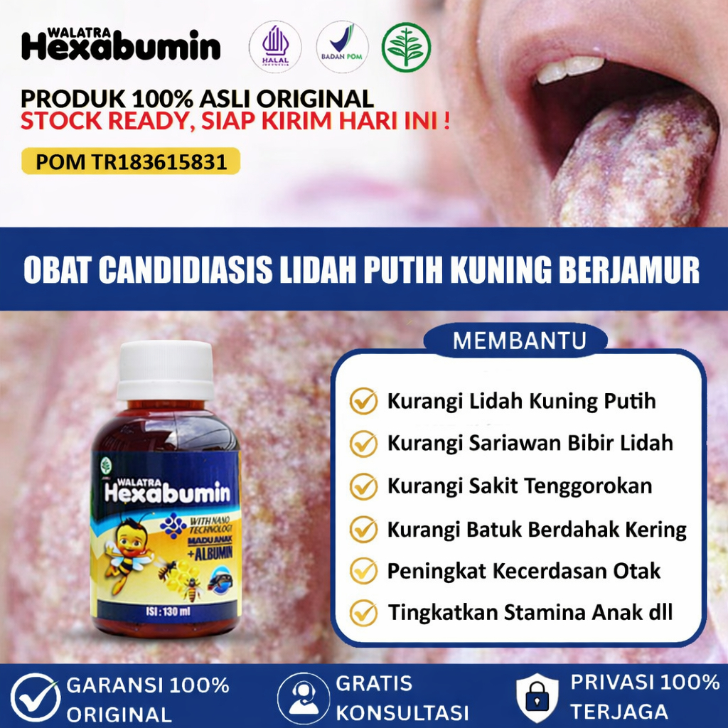 Obat Candidiasis Mulut, Lidah, Jamur Lidah, Mulut Berjamur, Becak Putih Atau   Kuning Di Lidah, Aman