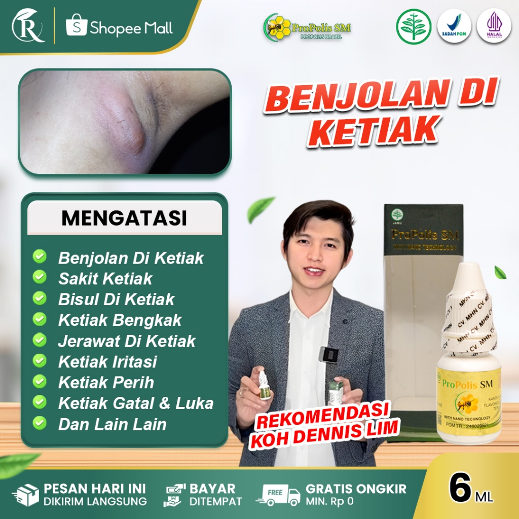 Obat Benjolan Di Ketiak Sakit Bila Ditekan Bisul Di Ketiak Bengkak dengan Propolis SM