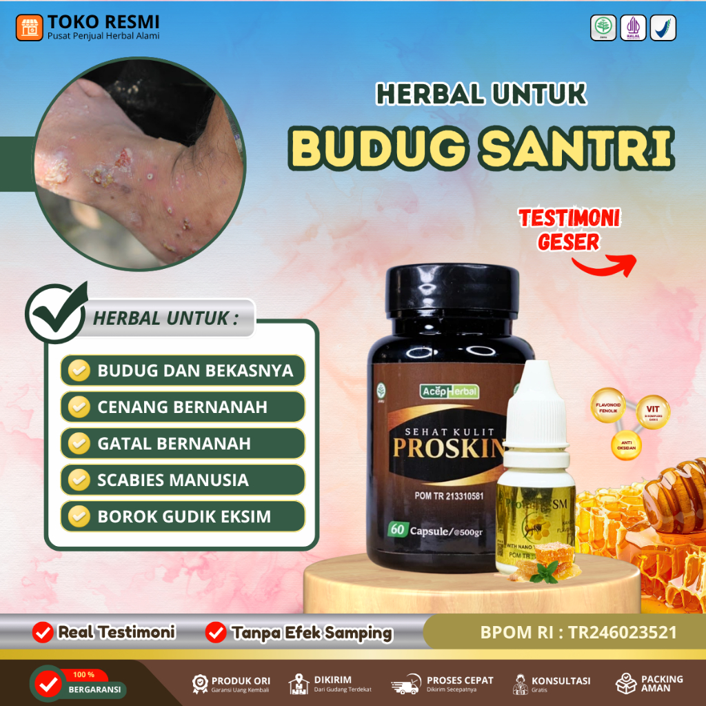 Obat Budug Bernanah, Obat Scabies Manusia, Obat Cenang Bernanah, Penghilang Korengan di kaki, Obat S