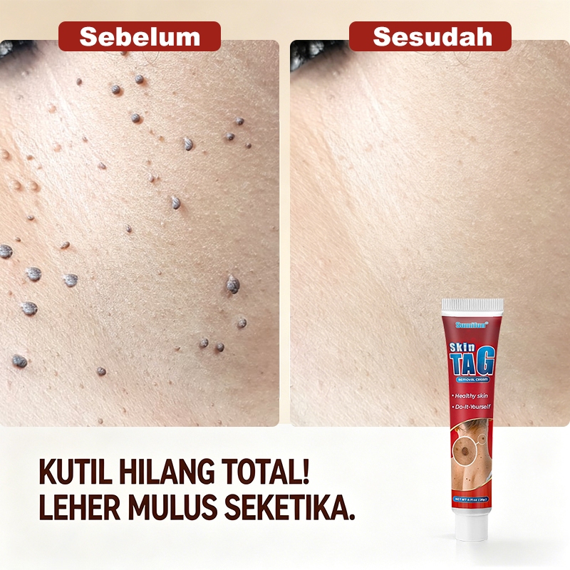 Obat untuk penghilang kutil | menghialngkan kutil area kelamin | produk penghilang papiloma | produk
