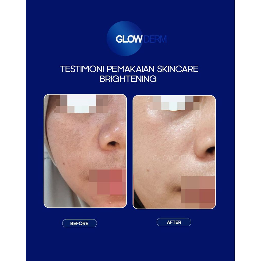 Glowderm Brightening