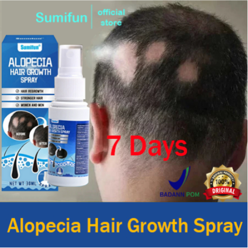 Obat Alopecia Areata penumbuh rambut cepat Obat penumbuh rambut botak pria Semprotan Penumbuh Rambut