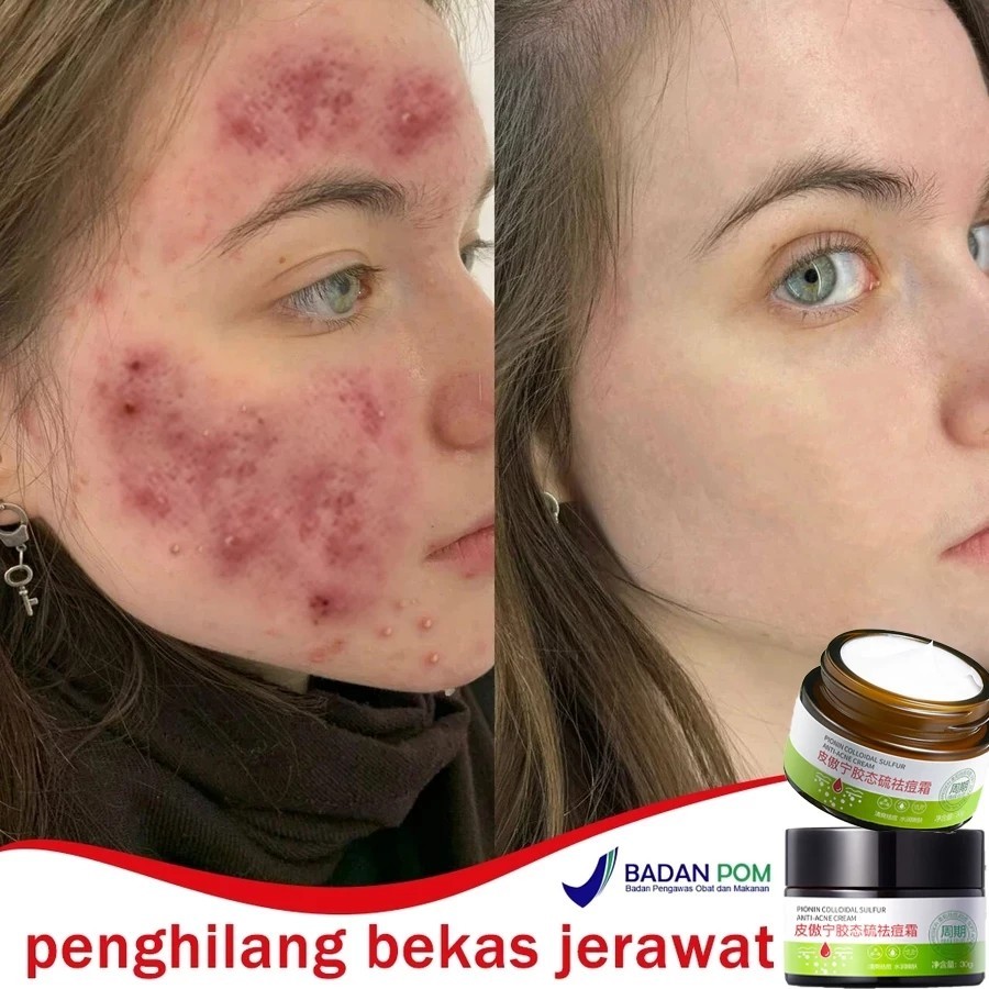 Krim Penghilang Bekas Jerawat Obat Lubang Jerawat Penghilang Bopeng Krim Wajah Penghilang Flek Hitam