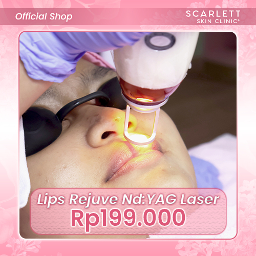 Lips Rejuve NdYAG Laser