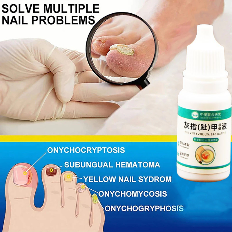 perawatan kuku infeksi jamur serum kuku jamur dan rusak	 oba jamur kuku kaki serum kuku obat kuku ja