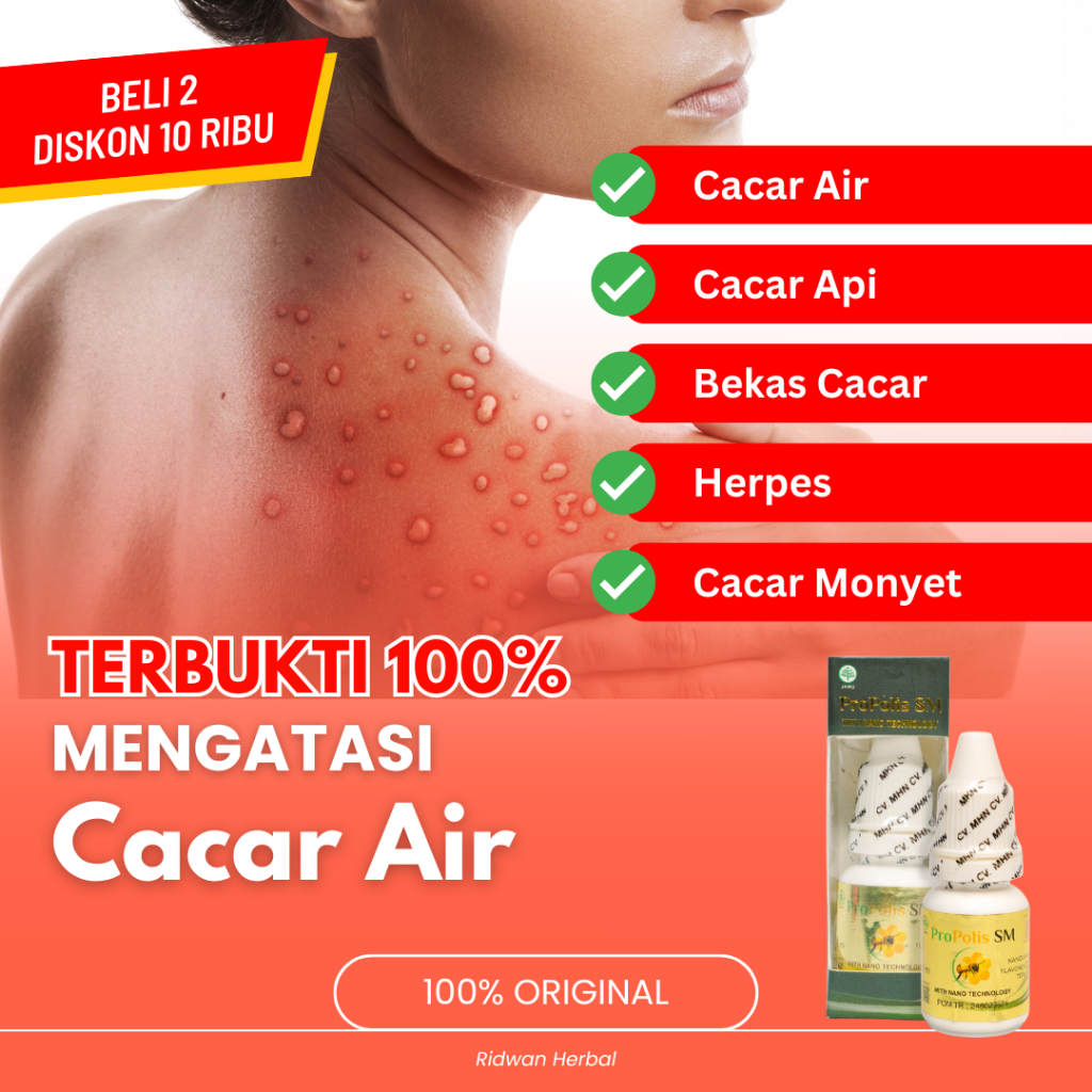 Obat Cacar Air, Obat Cacar Api, Obat Penghilang Bekas Cacar, Obat Herpes Kulit, Obat Cacar Monyet, O