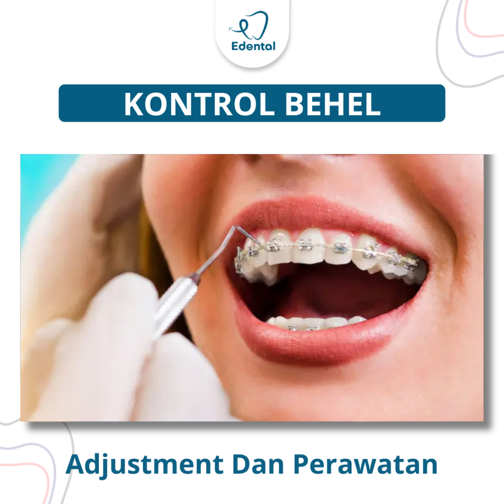 Kontrol Behel Gigi Edental - Ganti Karet & Aktivasi Kawat Gigi - Perawatan Rutin Behel Metal & Ceram