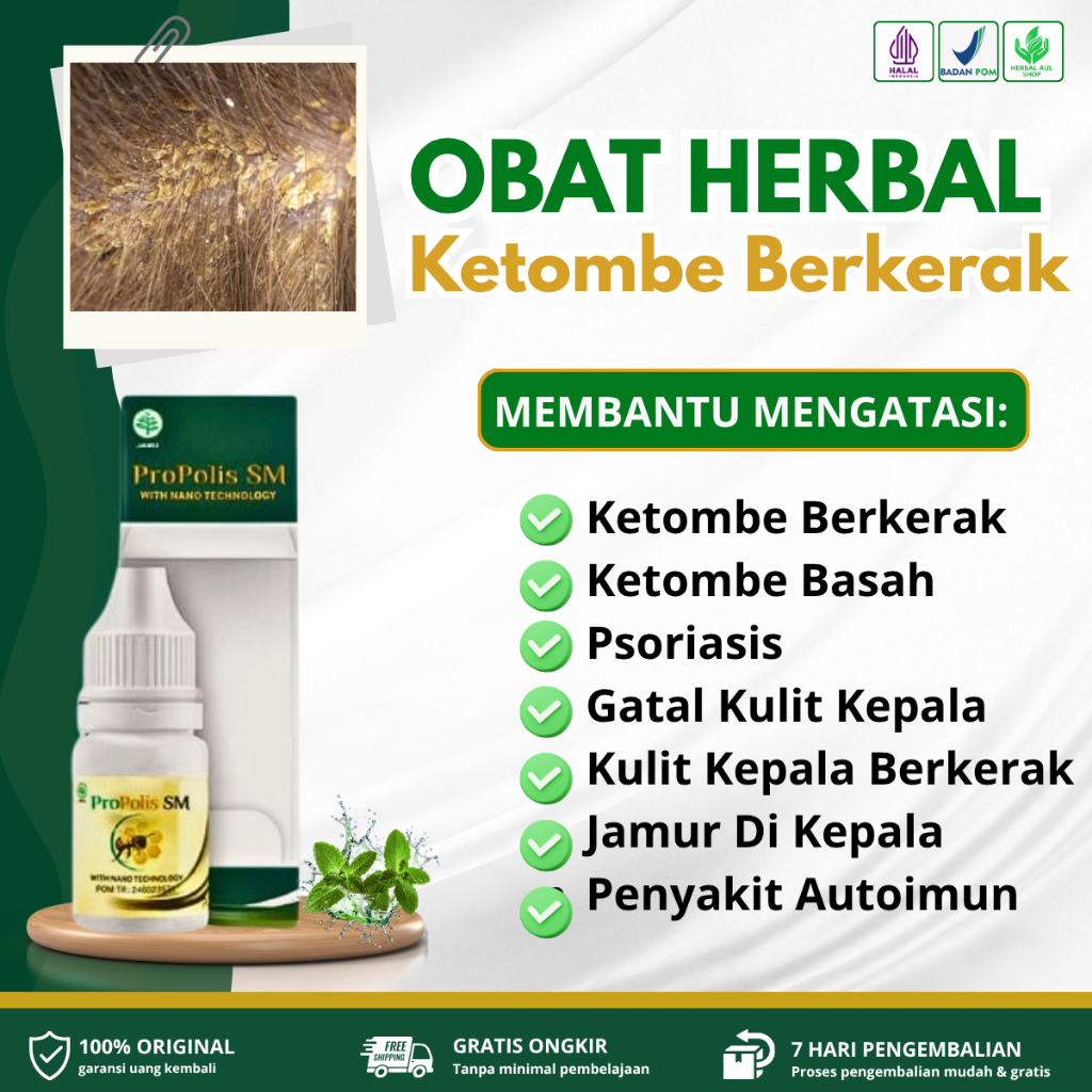 Propolis SM Obat Ketombe Berkerak, Ketombe Basah & Kering, Psoriasis, Gatal Kulit Kepala, Kulit Kepa