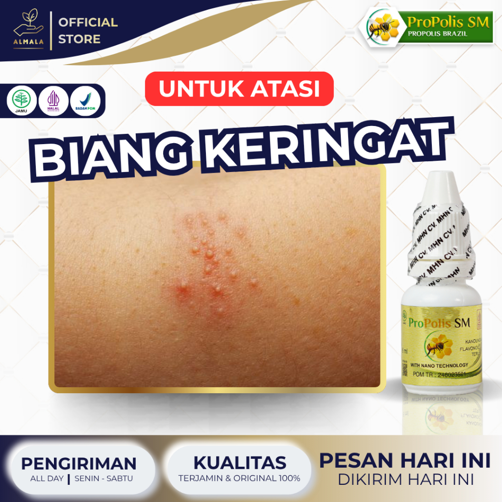 Obat Biang Keringat, Miliaria Rubra, Gatal Kulit, Gatal Seluruh Badan, Kaligata, Biduran, Bintik Bin