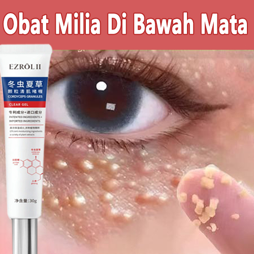 Krim Penghilang Milia 20g Krim Mata Agen Penghilang Milia Obat Milia untuk Bawah Mata Krim Milia Pen