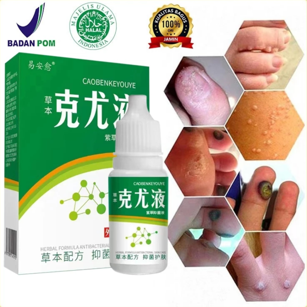 Obat Kutil Kelamin HPV, Obat kutil anus pria / wanita, Perontok Kutil kelamin alami, Obat kutil Kela