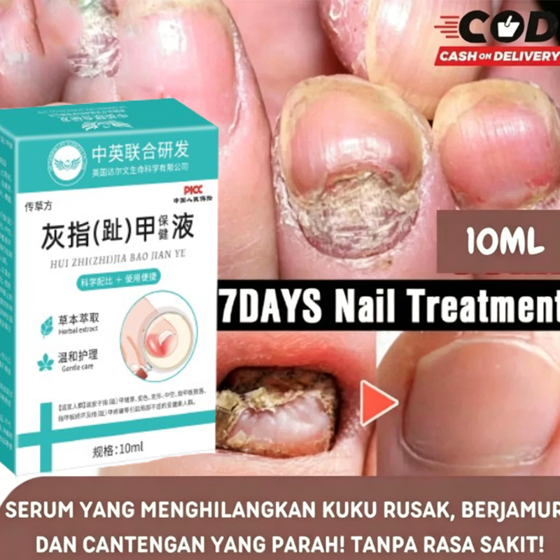 Essensi Perawatan Kuku Kaki 10ml Obat Jamur Kuku Ampuh