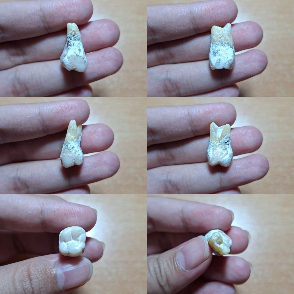 Gigi Molar RA