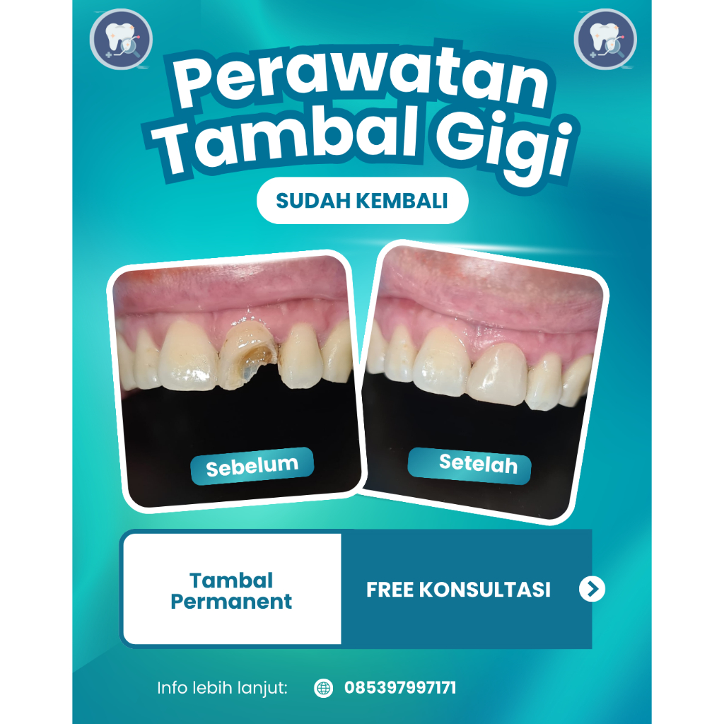 Tambal Gigi Depan + konsultasi Dokter