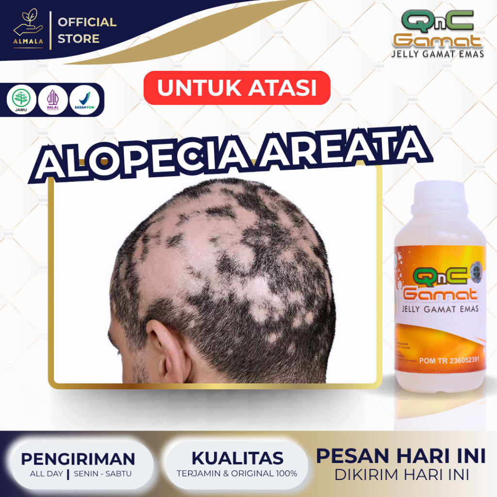 Obat Alopecia Areata, Obat Auto Imun, Penumbuh Rambut Kepala, Pencegah Rambut Botak, Obat Kebotakan 