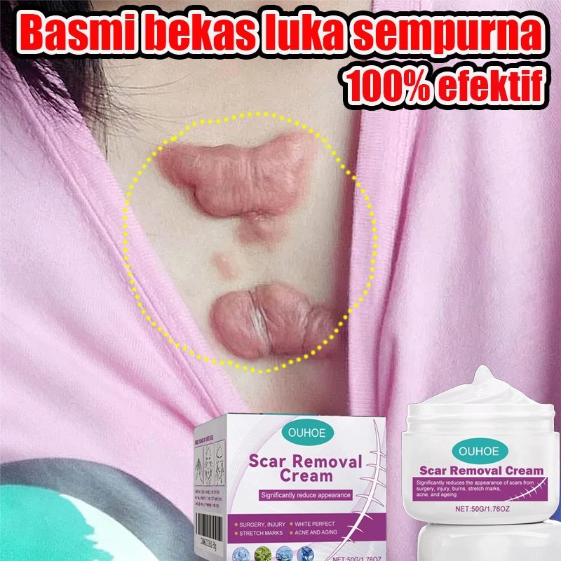 Salep penghilang bekas luka Penghilang bekas luka di kaki Bekas luka bakar Bekas lama Keloid Dengan 