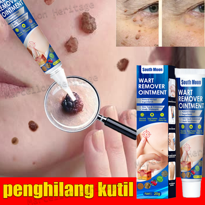Penghilang Tahi Lalat Di Wajah 0bat Kutil Ampuh Ori Penghilang Kutil Dan Tahi Lalat Obatpenghilang T