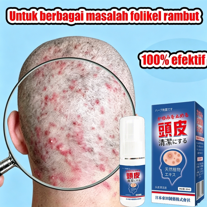 Semprotan Kulit Kepala Obat Ketombe Membandel Obat Ketombe Berkerak Dermatitis seboroik Obat jamur k
