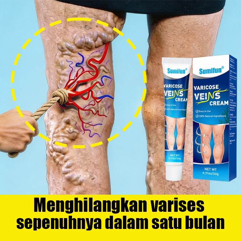 Varicose Veins Cream Varises Salep Penghilang Varises Vaskulitis Veins Salep Cream Varises Kaki dan 