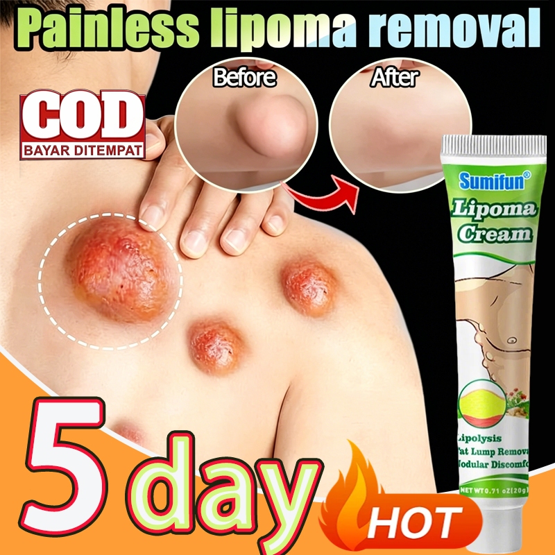 Obat Benjolan Lipoma Obat herbal Cina Krim lipoma 20g Perawatan punggung/leher/paha Kanker Tumor Kel