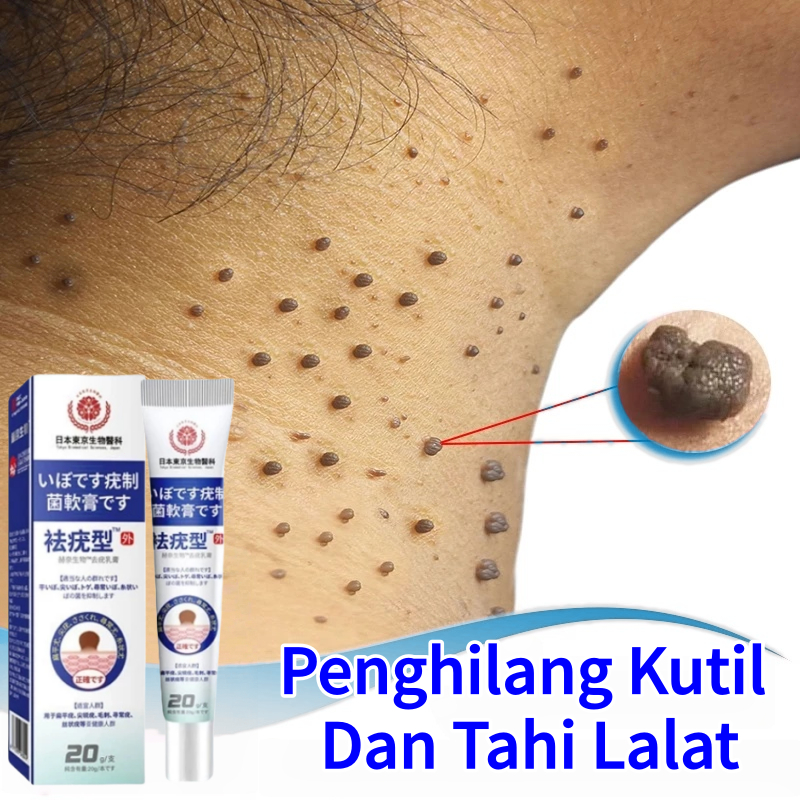 Obat kutil Penghilang kutil Salep kutil paling ampuh Menghilangkan kutil dan tahi lalat Kutil Di Waj